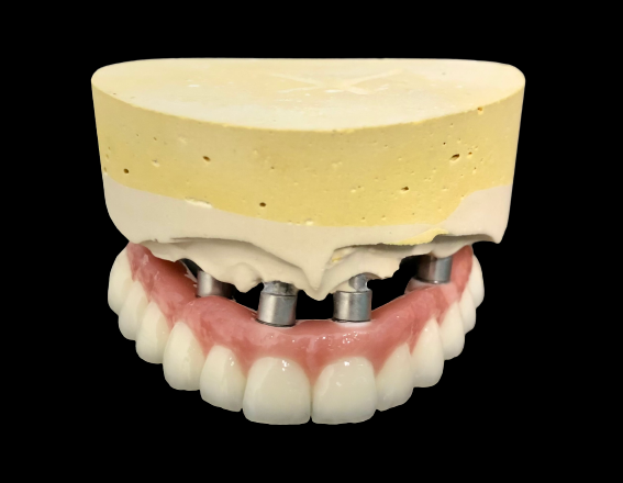 leczenie implantologiczne odbudowa zebow 1