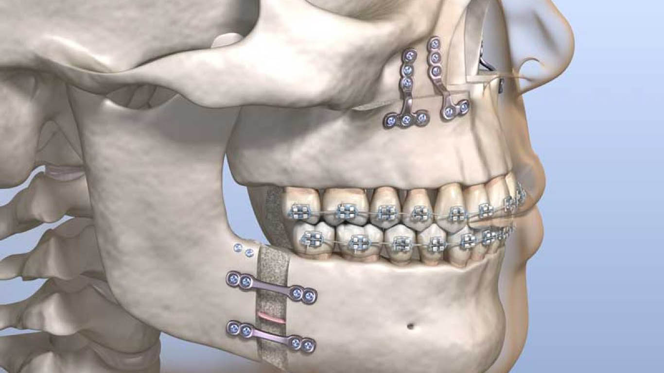 Orthognathic surgery