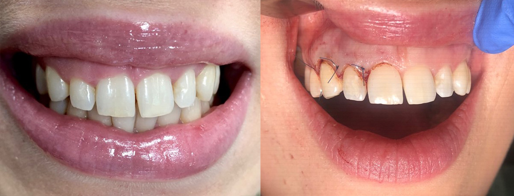 Zabieg gingiwoplastyki 1