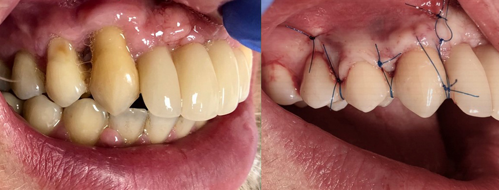 Zabieg pokrycia recesji dziaslowej 1