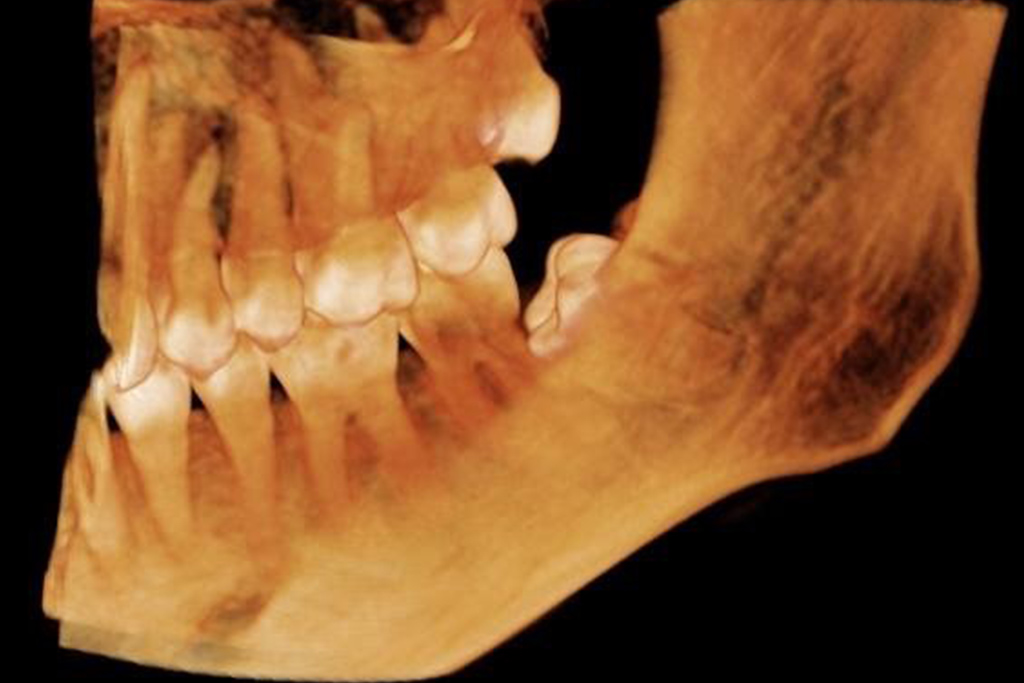 chirurgiczne ekstrakcje zebow 1