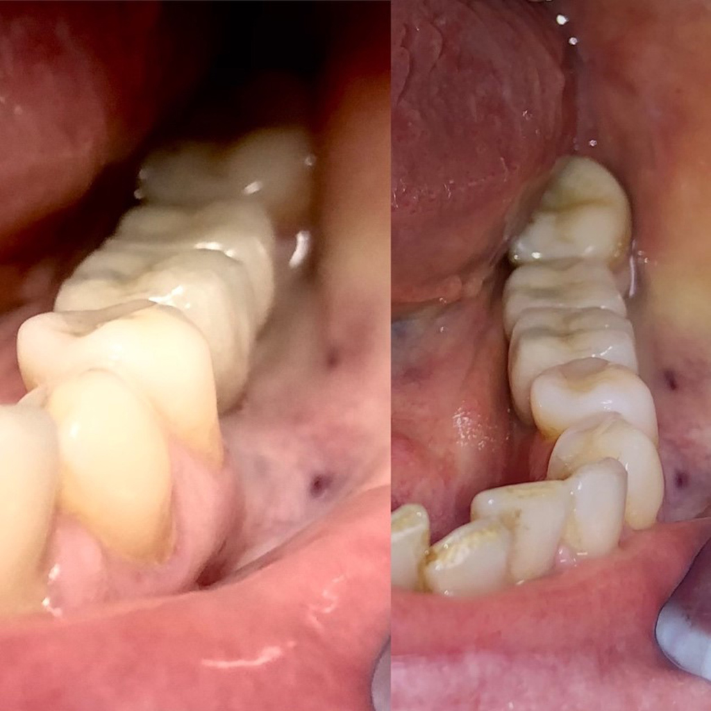 odbudowa braku zebow na implantach przed po