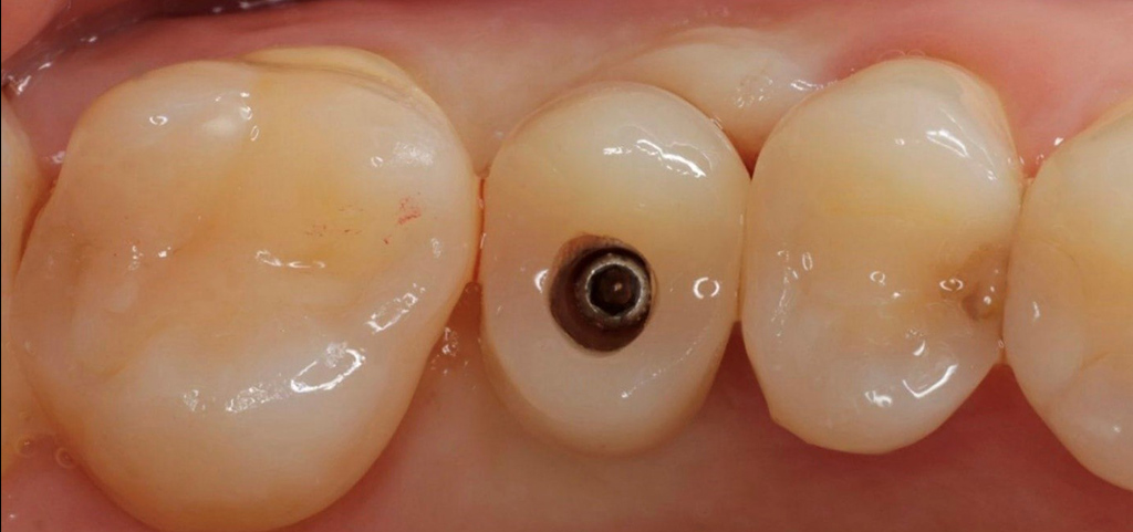 odbudowa braku zebowego na implantach 1