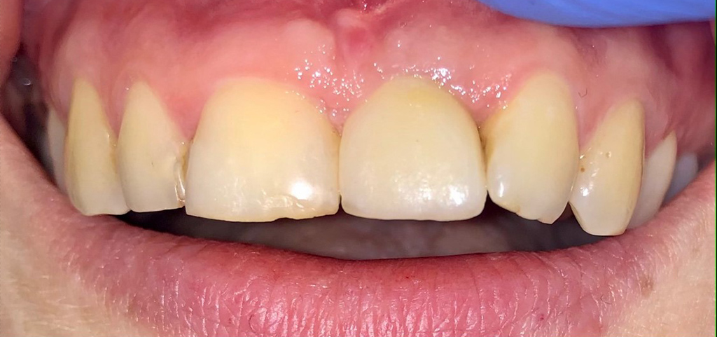 wyglad jamy ustnej po zabiegu rekonstrukcji