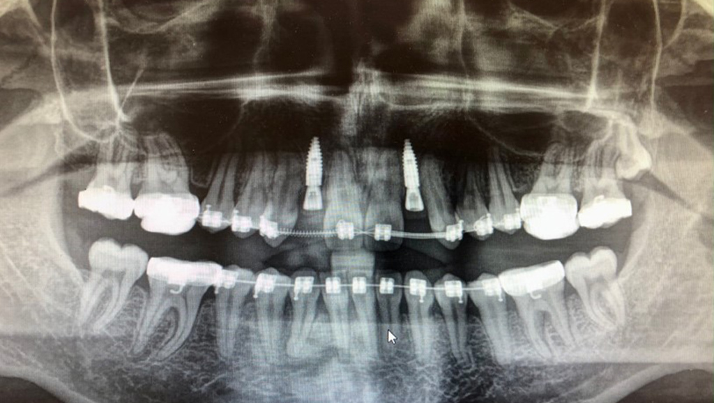 zdjecie rtg opg z aparatem i implantami