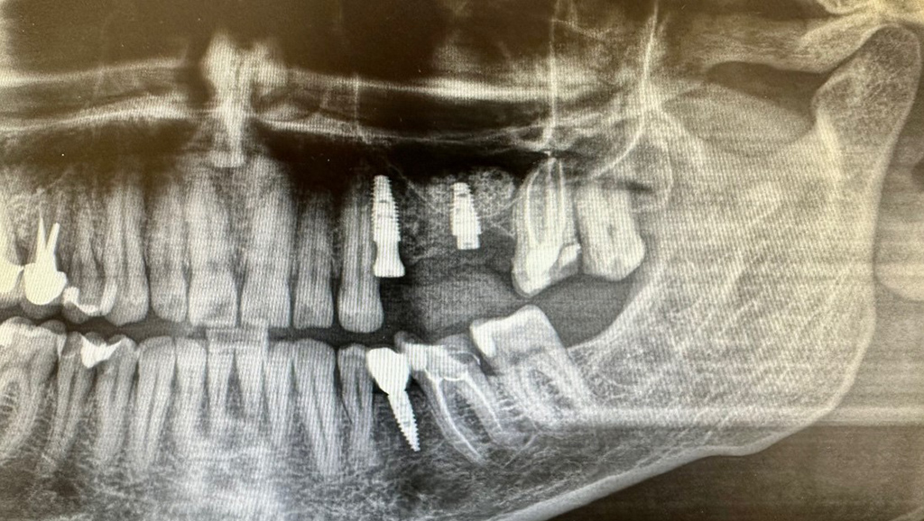 zdjecie rtg po zabiegu implantacji