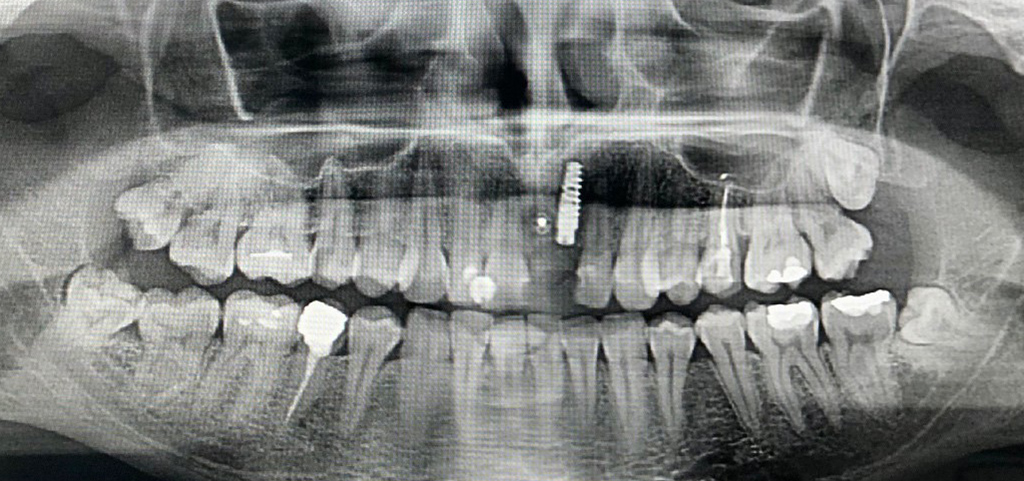 zdjecie rtg po zabiegu rekonstrukcji kostnej