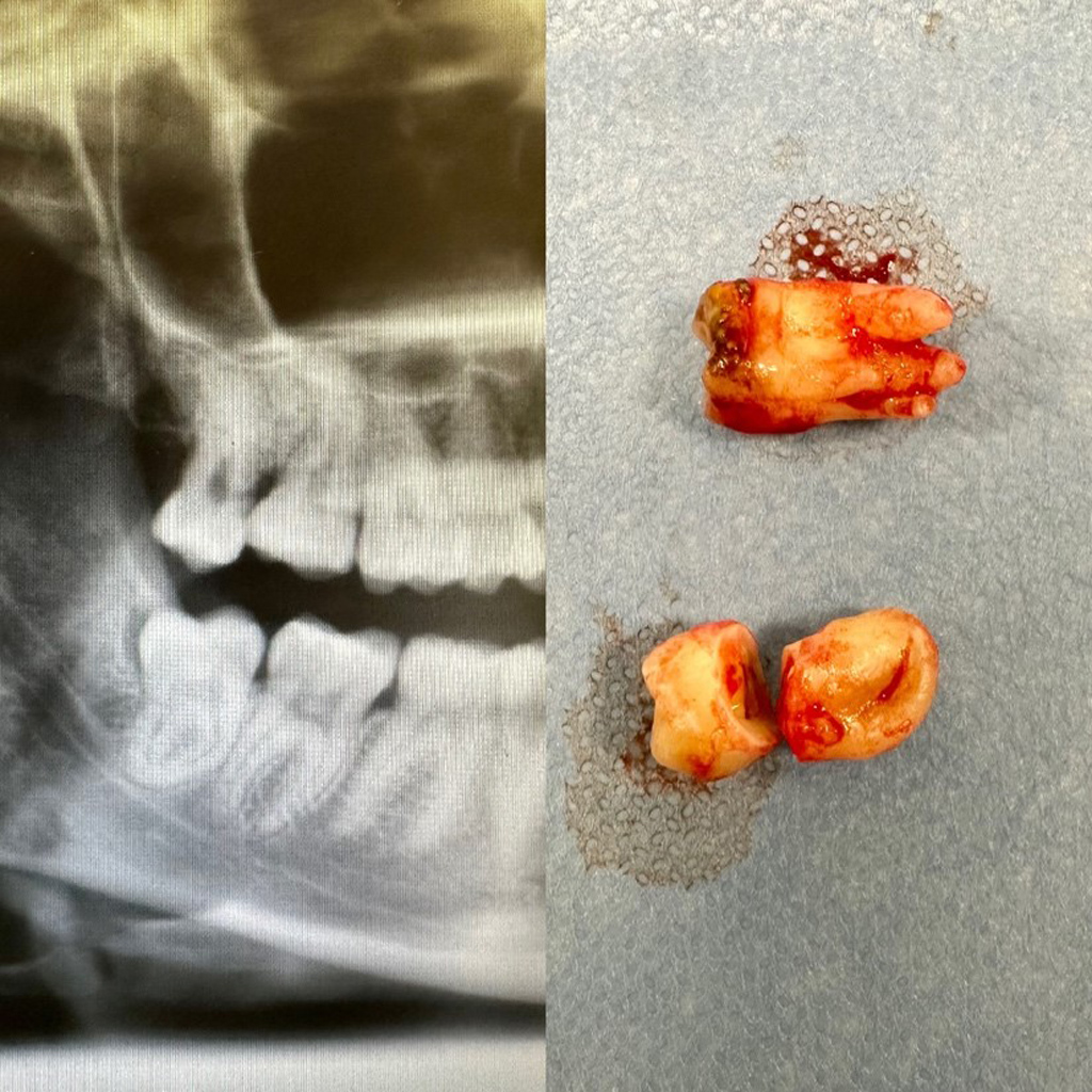 zdjecie rtg usunietych zebow 18 48