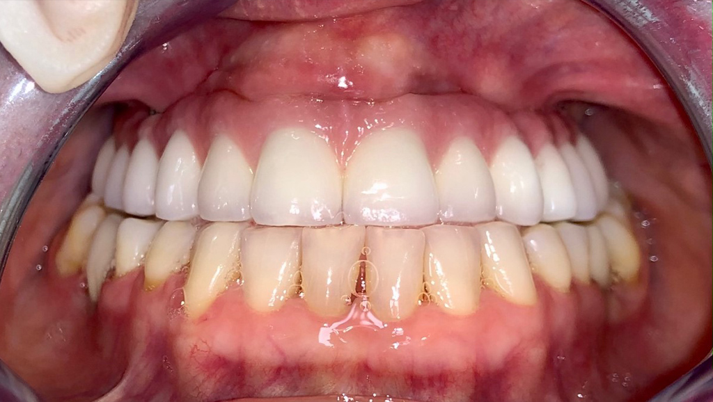 leczenie implantologiczne odbudowa zebow 1