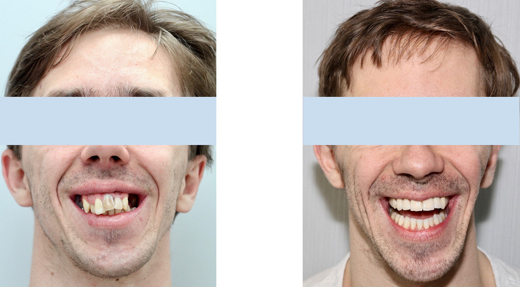 metamorfoza przed po